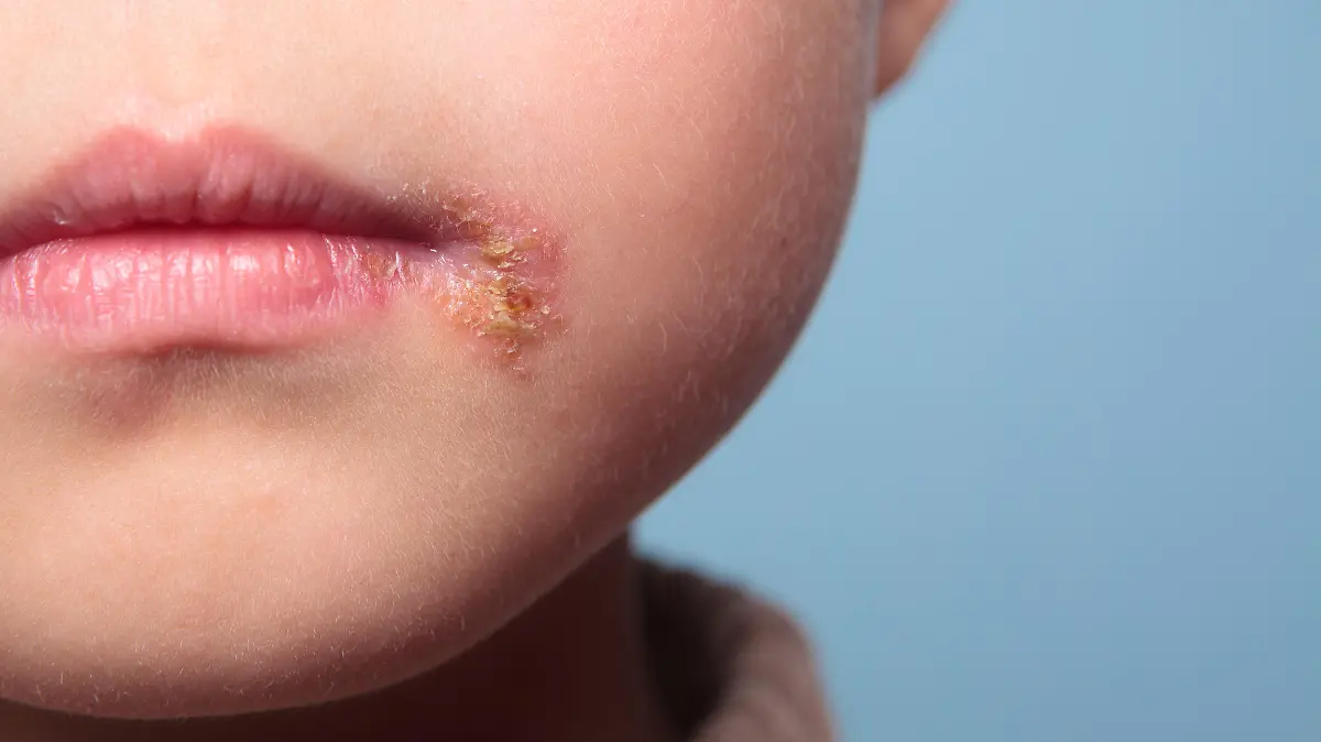 Kind mit Fieberbläschen an der Lippe
