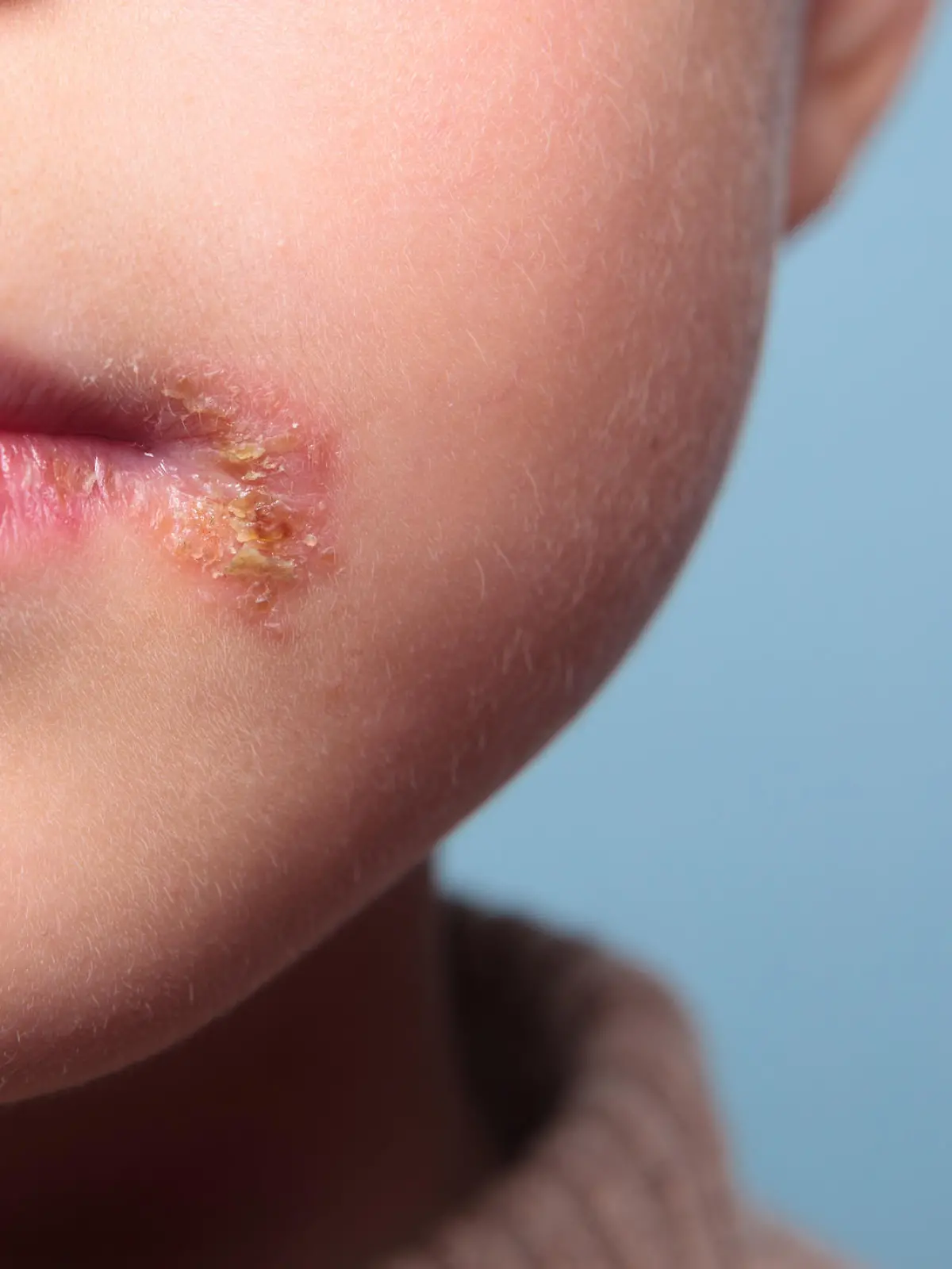Kind mit Fieberbläschen an der Lippe
