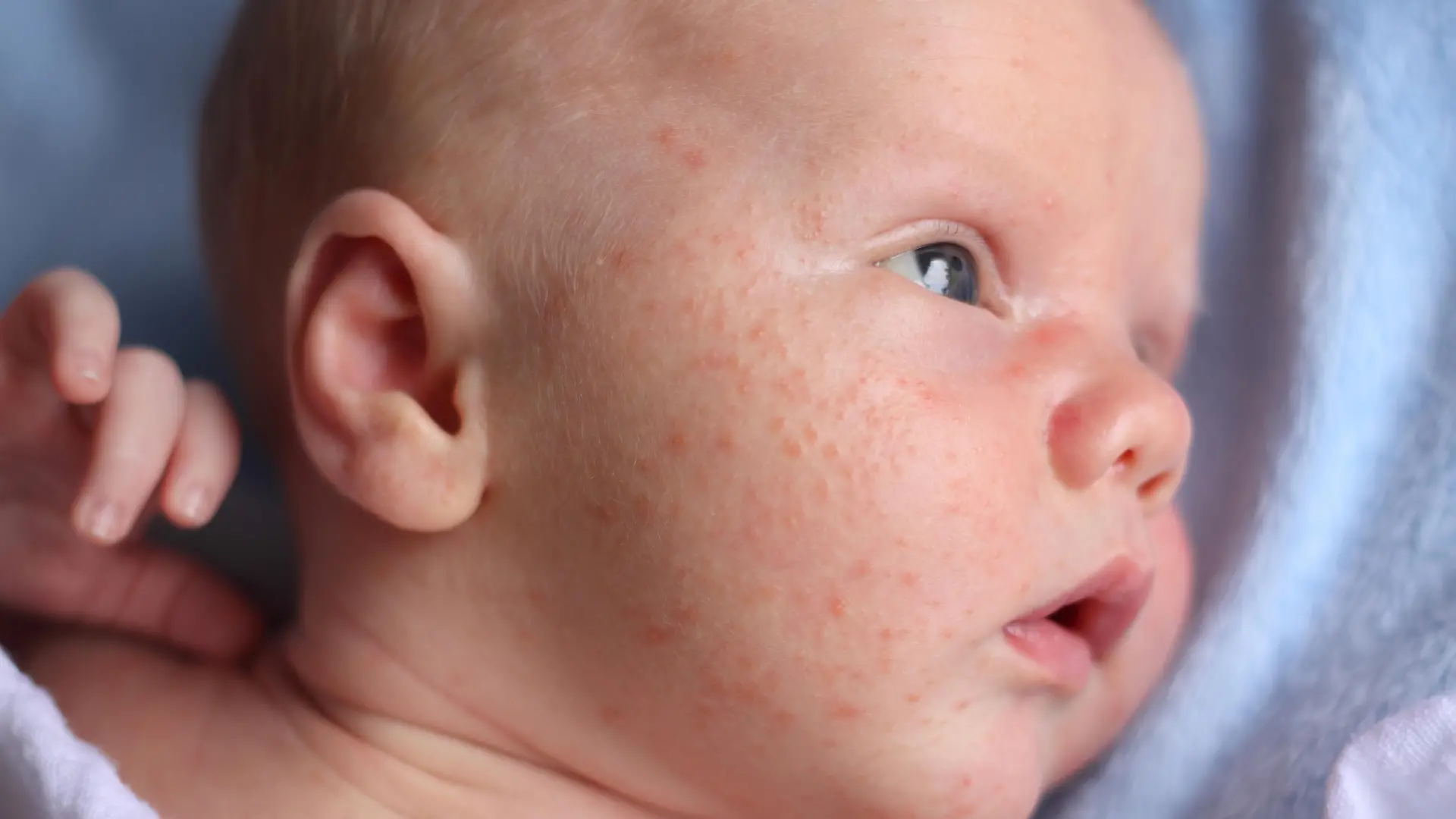 Baby mit Milien bzw. Pickeln im Gesicht
