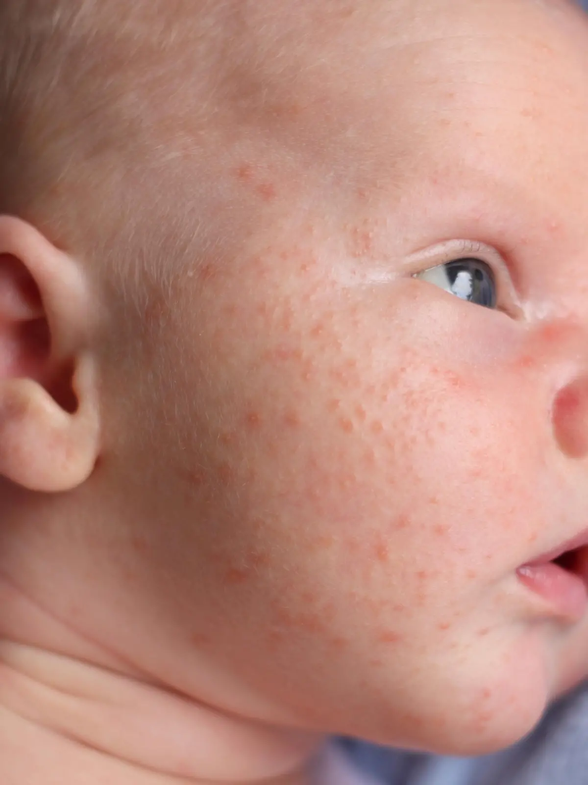 Baby mit Milien bzw. Pickeln im Gesicht