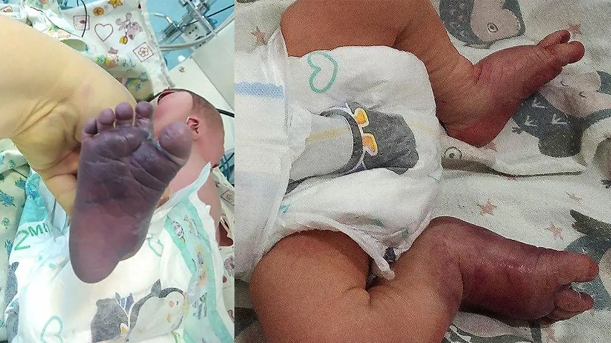 Russland: Baby werden bei Geburt beide Beine durch unqualifizierte Hebamme gebrochen