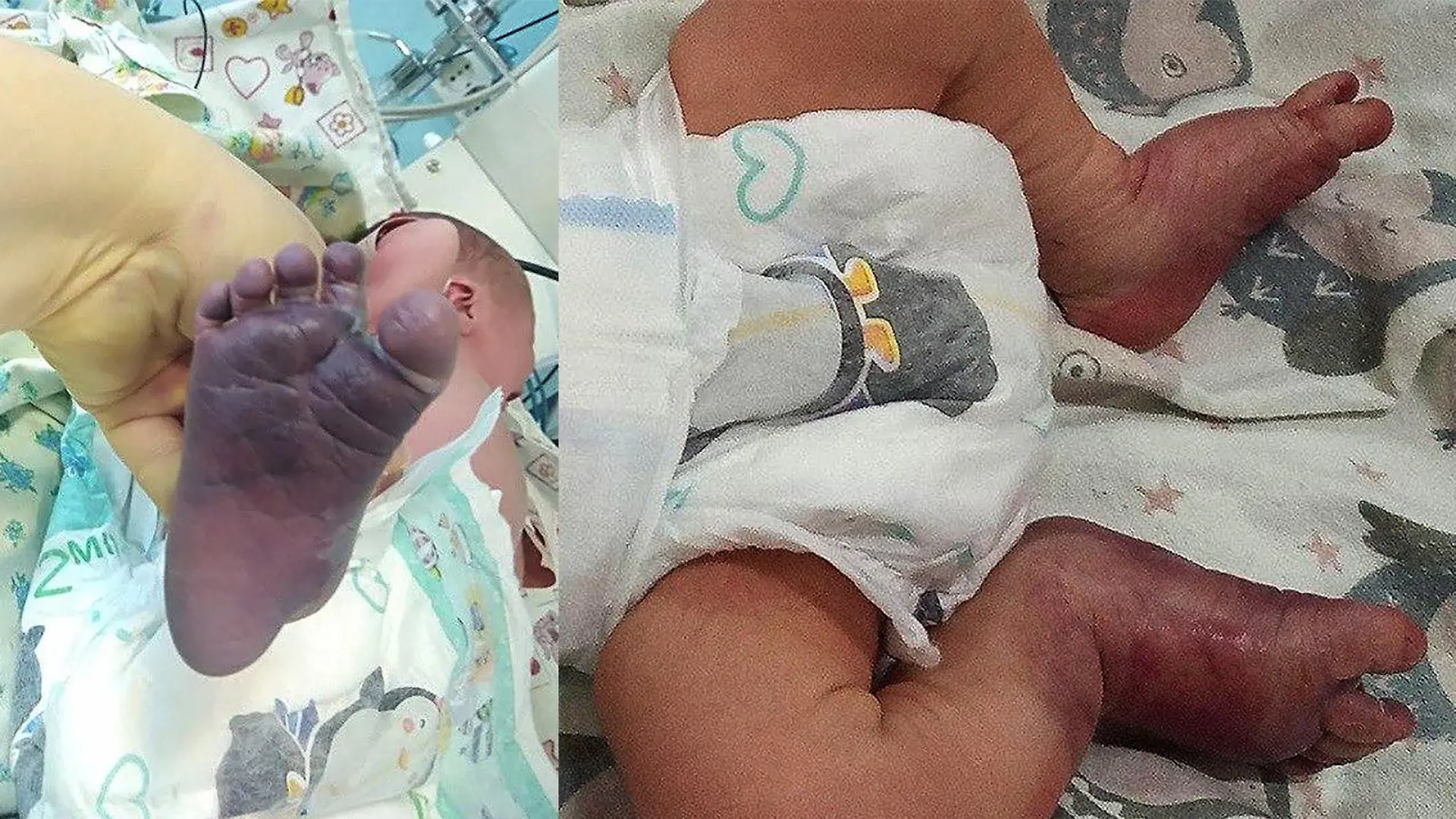 Russland: Baby werden bei Geburt beide Beine durch unqualifizierte Hebamme gebrochen