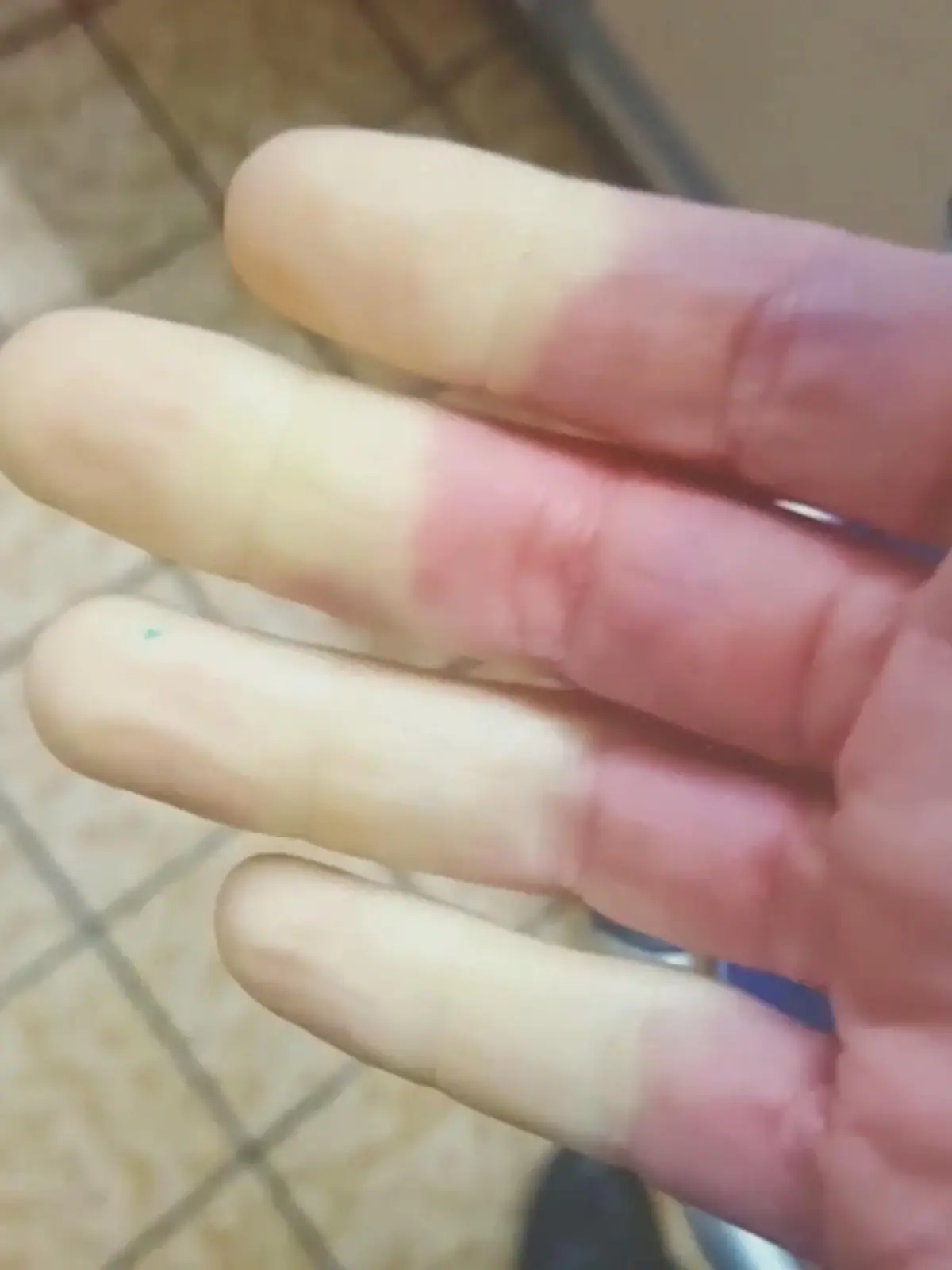 Bild zu: "So schmerzhaft ist das Raynaud-Syndrom"