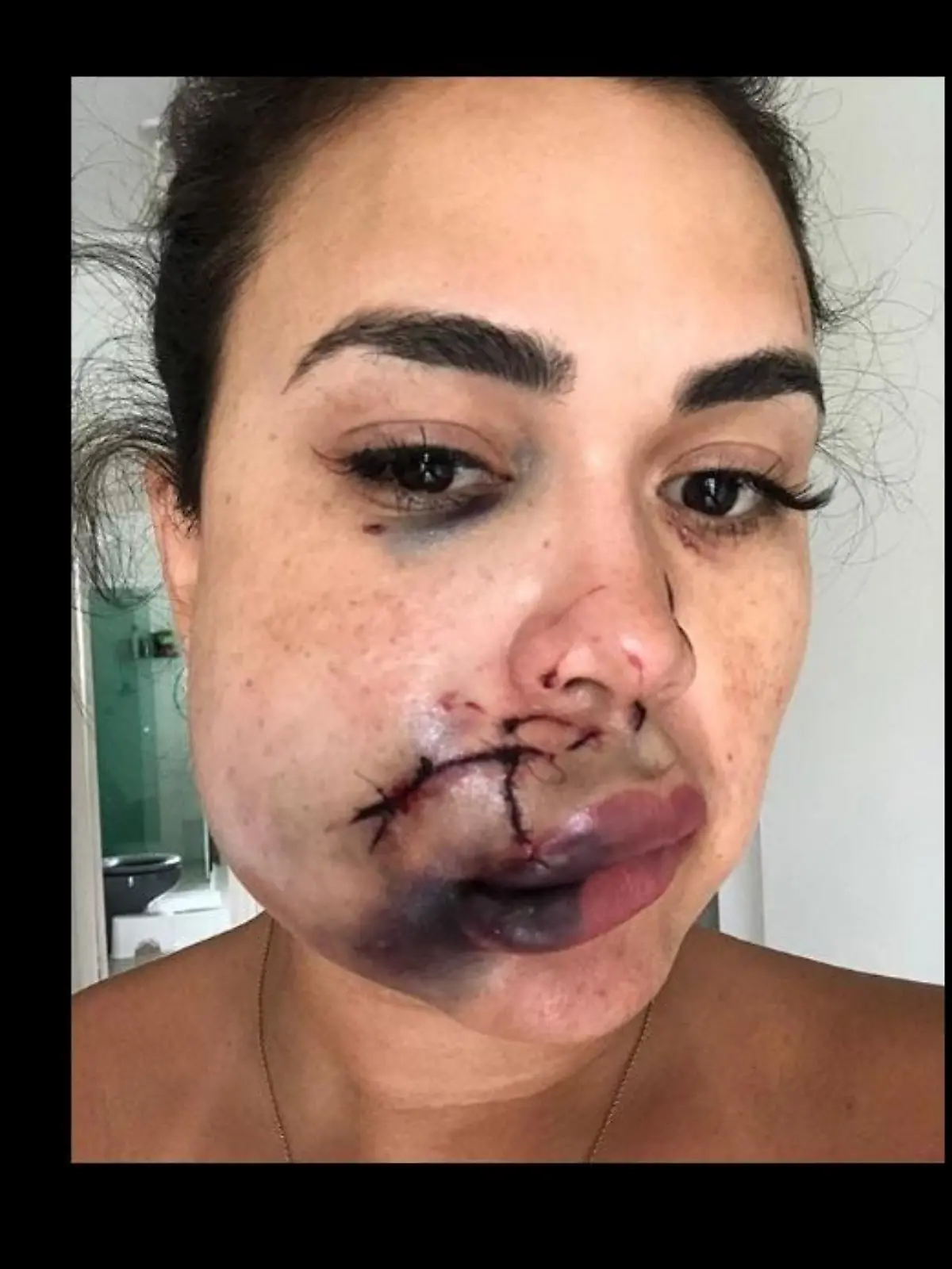 Milka Borges mit schweren Gesichtsverletzungen
