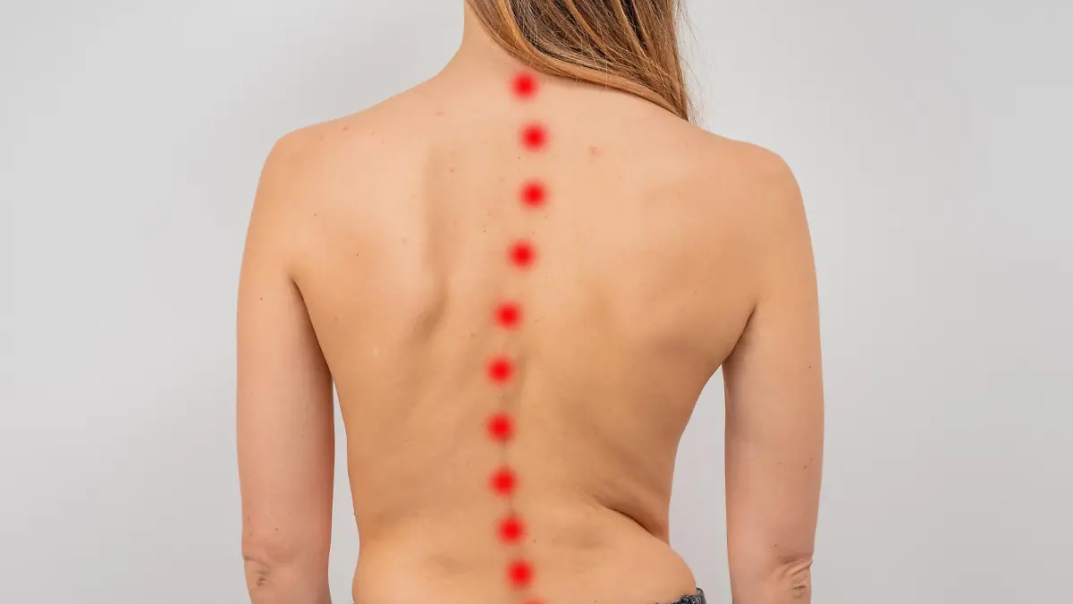Woman with scoliosis of the spine. Curved woman's back with acne skin.