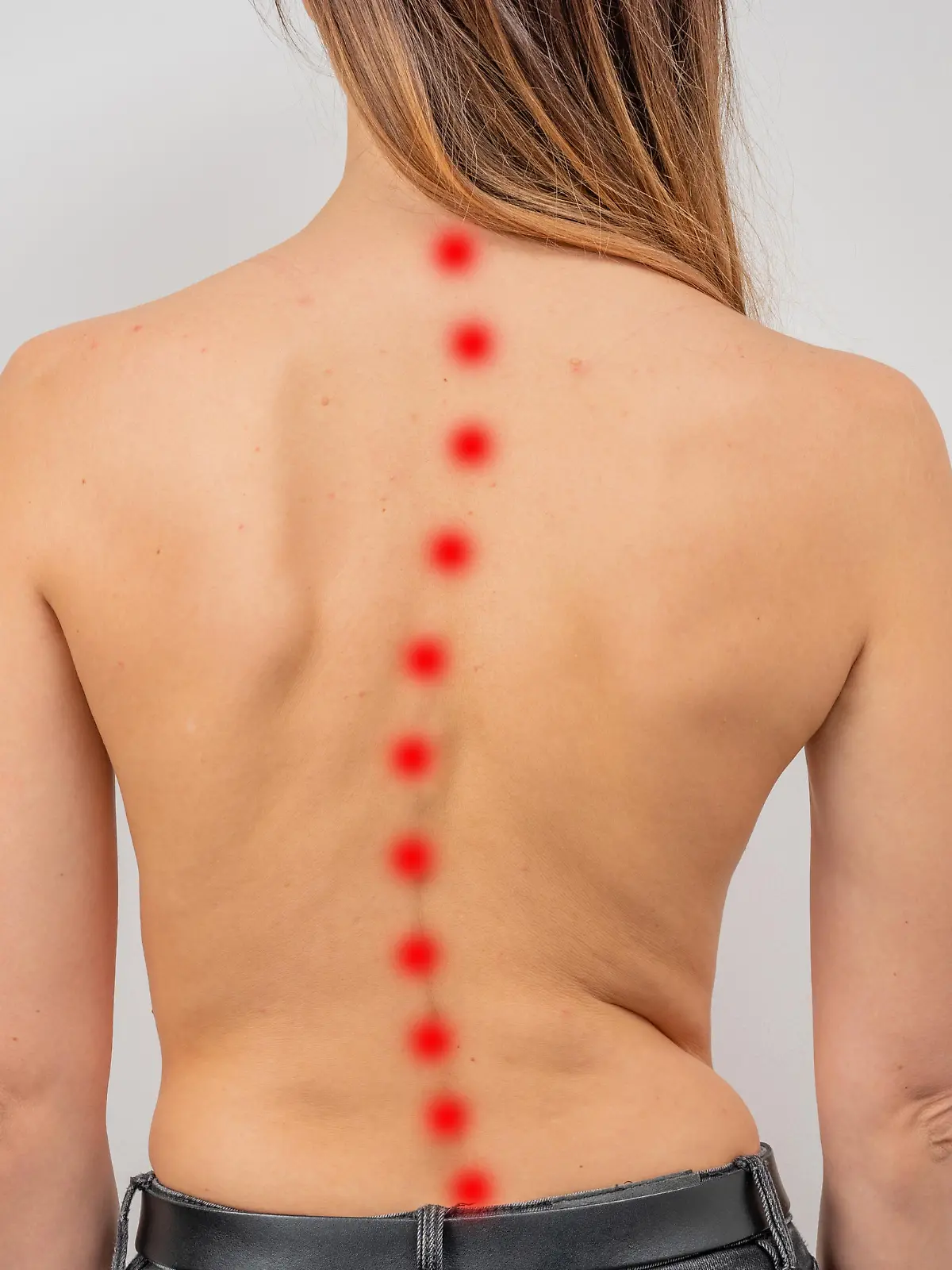 Woman with scoliosis of the spine. Curved woman's back with acne skin.