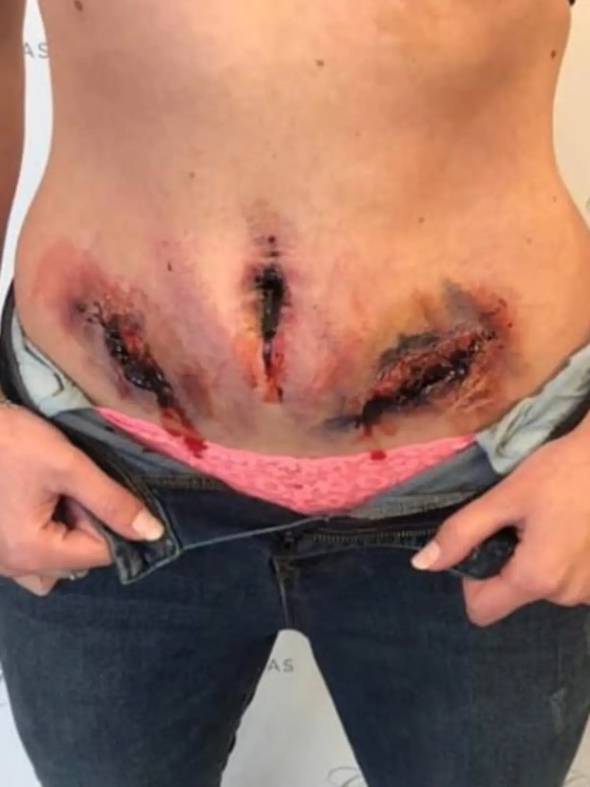 Bild zu: "Wenn Endometriose sichtbar wäre"