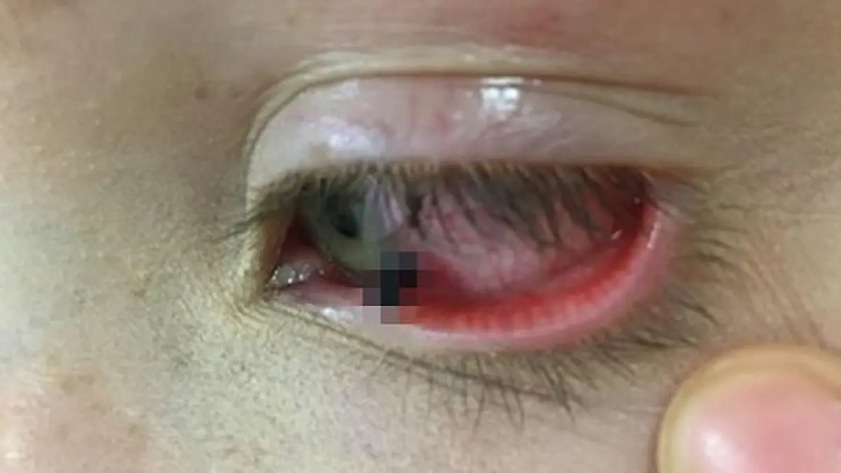 Dem Mädchen ragte ein Teil des Bleistifts aus dem Auge.