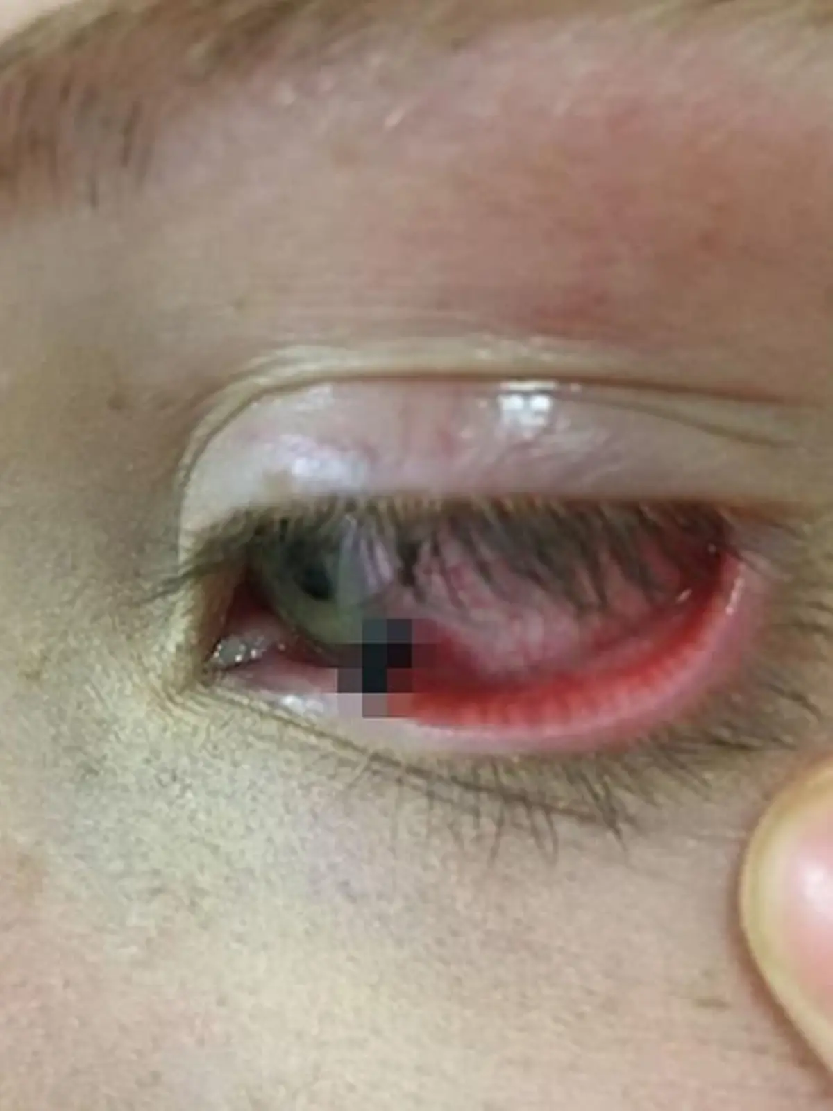 Dem Mädchen ragte ein Teil des Bleistifts aus dem Auge.
