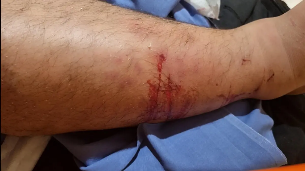 Kerims Schienbein nach dem Weltrekord -gezeichnet von den Baseball-Schlägern.