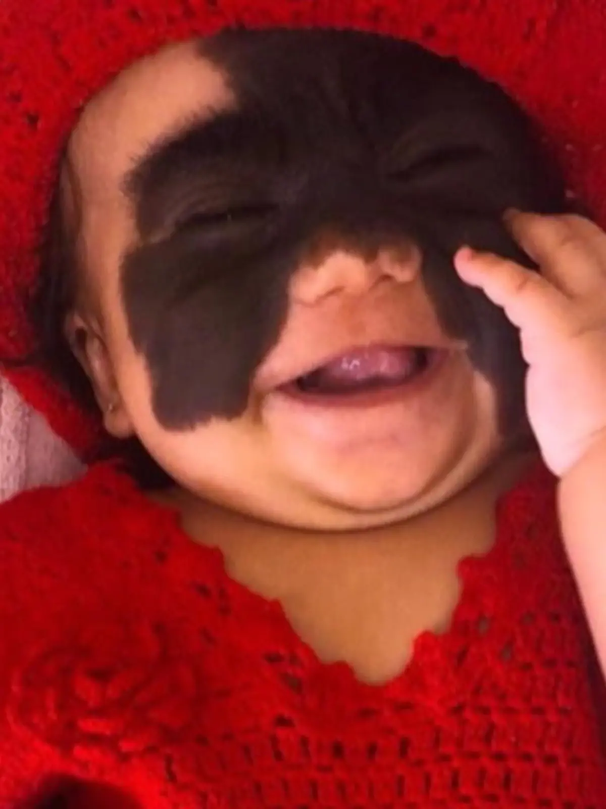 Bild zu: "Hoffnung für Baby mit Riesen-Muttermal"