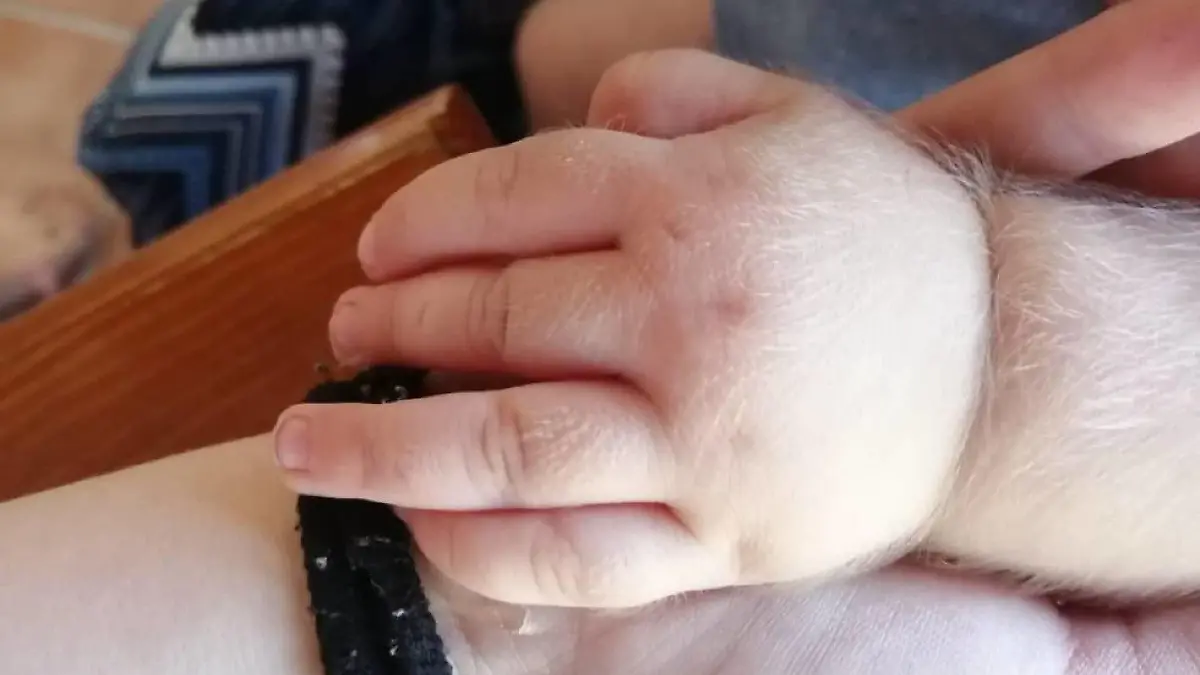 Baby mit Werwolf-Syndrom