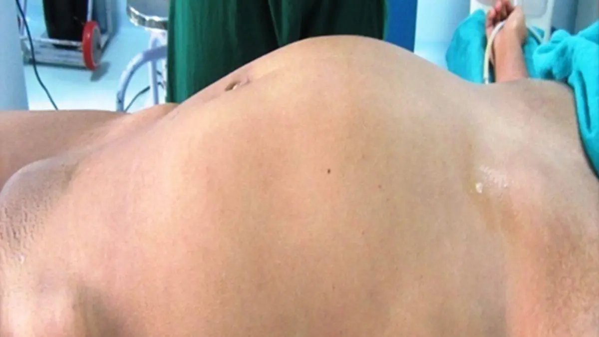 Geschwollener Bauch von Inderin.