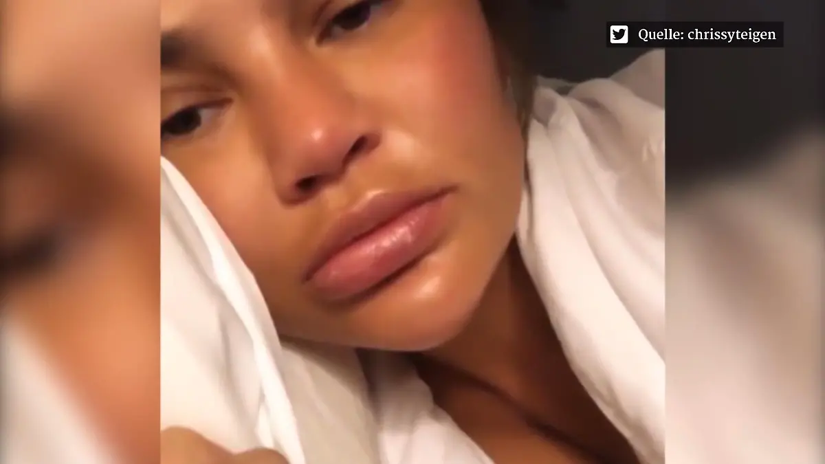 Chrissy Teigen teilt Schockbilder im Netz Dicke-Lippe-Alarm
