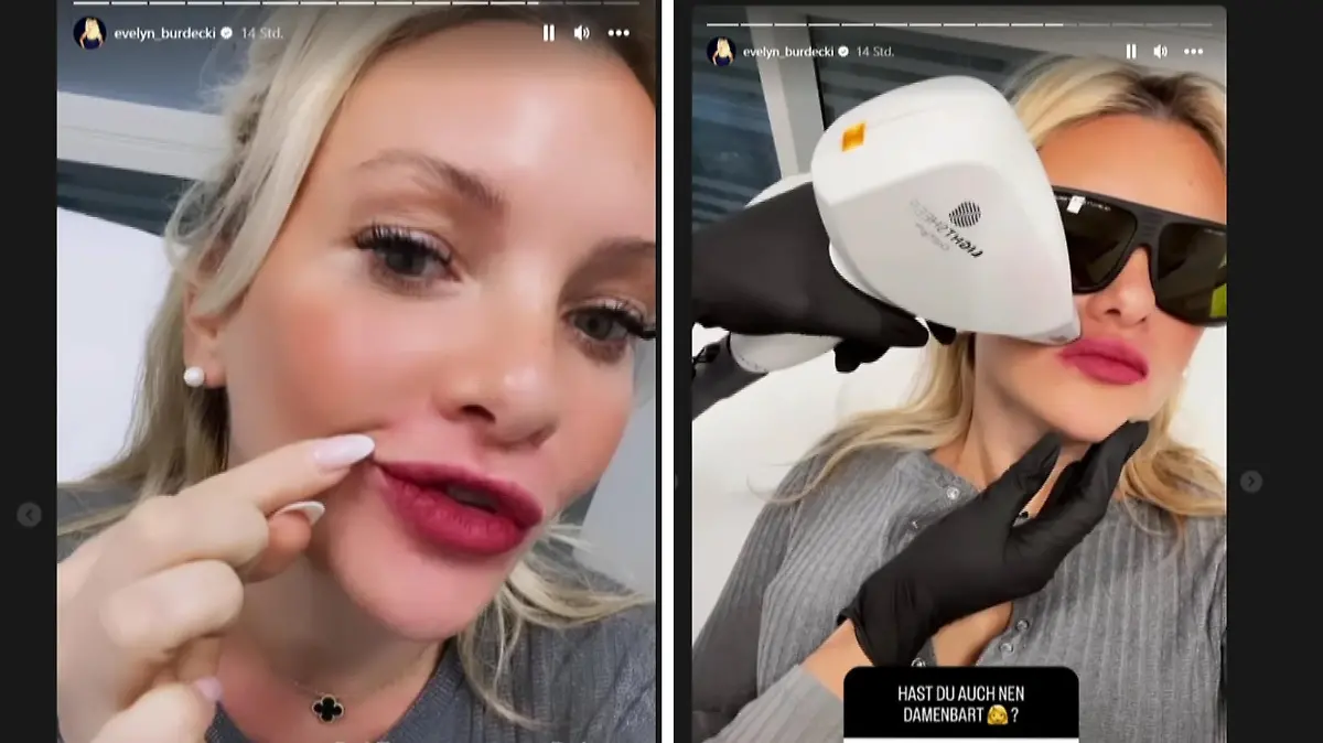 Es brennt und kribbelt, aber um "Bart frei" zu sein, nimmt Evelyn Burdecki das gerne auf sich.