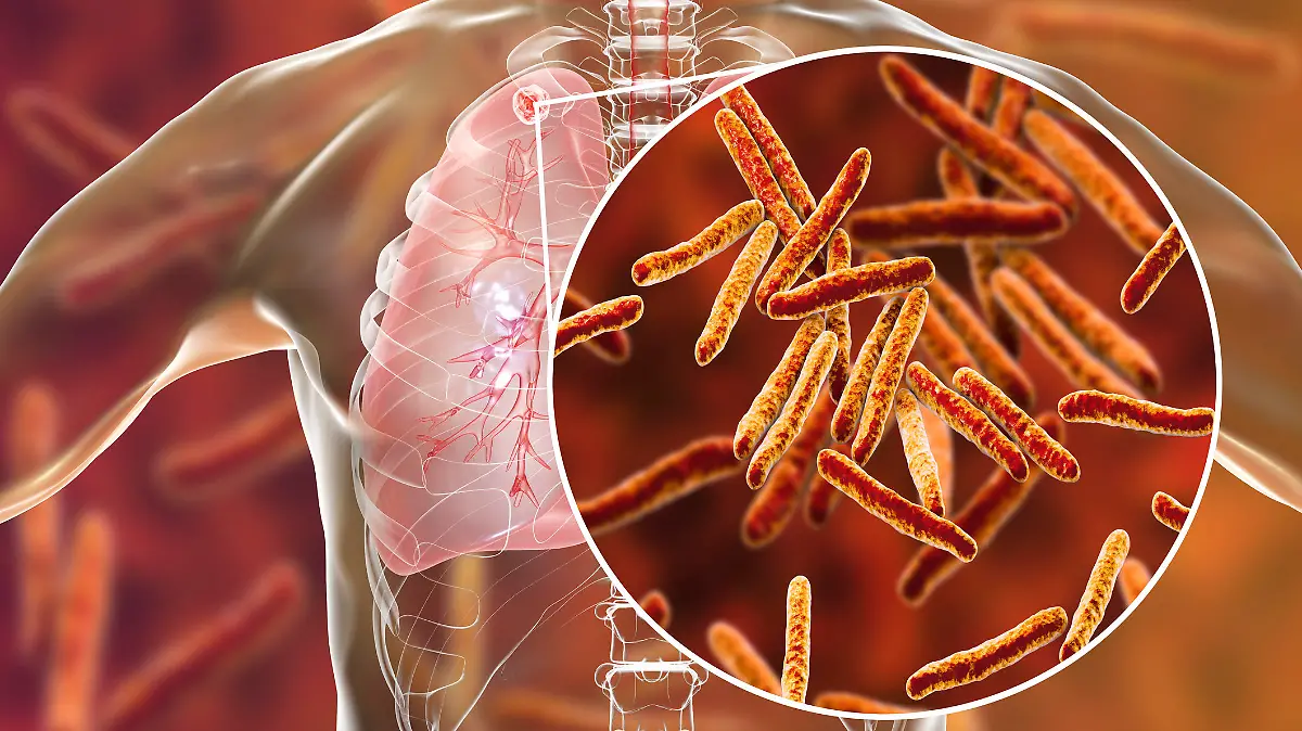 Mycobacterium-Tuberkulose-Bakterien in der Lunge