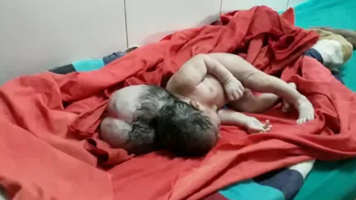 Enzephalozele: Baby mit seltener Krankheit geboren.