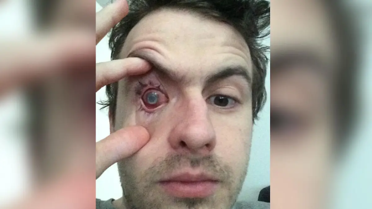 Nick after contracting the infection (PA Real Life/Collect)
