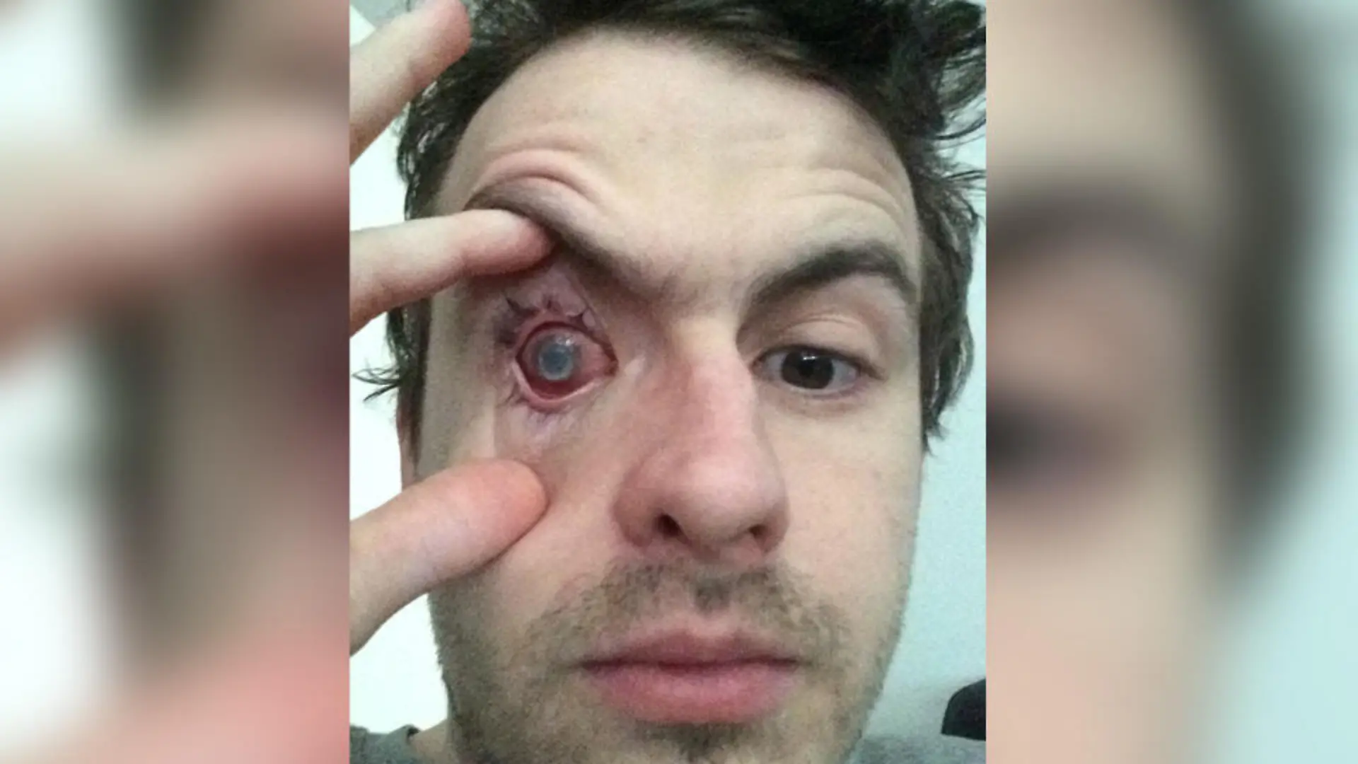 Nick after contracting the infection (PA Real Life/Collect)
