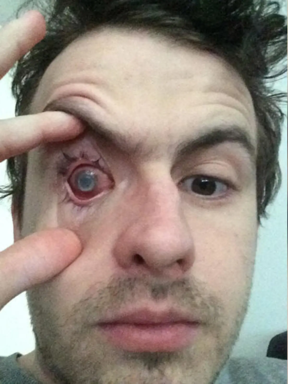 Nick after contracting the infection (PA Real Life/Collect)