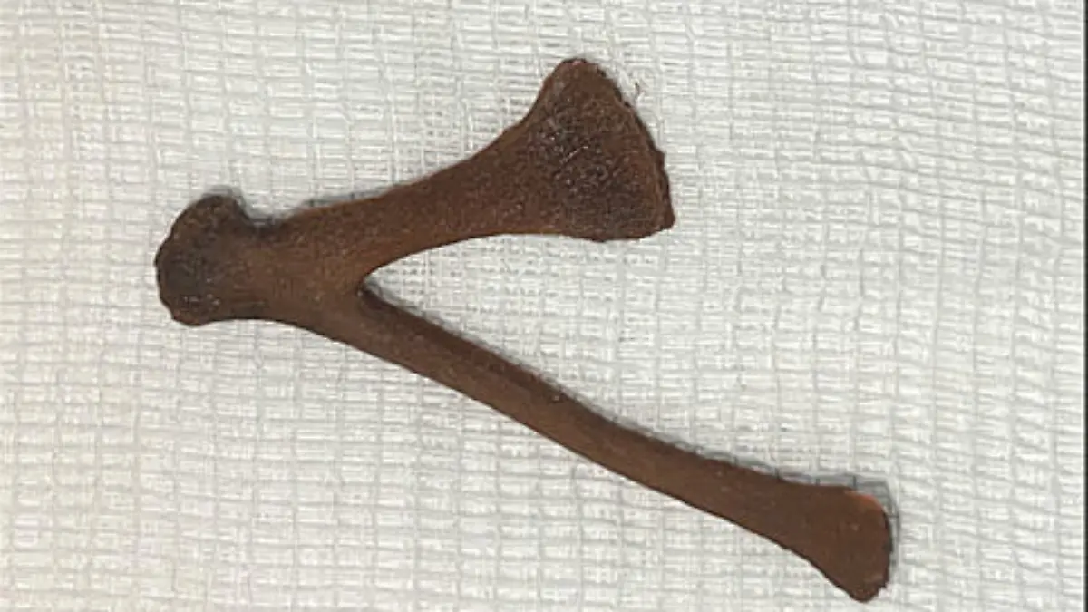 Story from Jam Press (Chicken Bone)
Pictured: The bone after it was removed.
Woman rushed to hospital after chicken bone gets stuck in her bum.
A woman was rushed to hospital after getting a chicken bone stuck in her bum.
The unnamed woman accidentally swallowed the V-shaped bone after failing to chew her food properly.
The 51-year-old had lost her upper teeth giving her a habit of swallowing her food fast.
She didn't experience any choking or stomach pains after swallowing the triangular-shaped bone.
But when she later went to the toilet she was shocked to find part of the V-shaped bone sticking out of her bottom.
She was rushed to hospital where doctors performed pelvic CT scans.
The 3D scans show the 5cm x 3cm bone firmly wedged in her bottom.
Doctors successfully removed the bone with gentle force before giving the woman gel to numb the area.
The woman, from Kuwait, was told by doctors to chew her food properly and has now been referred to a dentist.
Swallowing chicken bones have been known to be fatal.
The findings were reported in Cureus medical journal.
ENDS