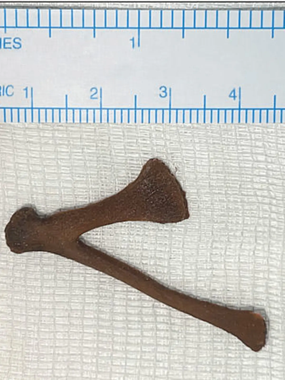 Story from Jam Press (Chicken Bone)

Pictured: The bone after it was removed.

Woman rushed to hospital after chicken bone gets stuck in her bum.

A woman was rushed to hospital after getting a chicken bone stuck in her bum.

The unnamed woman accidentally swallowed the V-shaped bone after failing to chew her food properly.

The 51-year-old had lost her upper teeth giving her a habit of swallowing her food fast.

She didn't experience any choking or stomach pains after swallowing the triangular-shaped bone.

But when she later went to the toilet she was shocked to find part of the V-shaped bone sticking out of her bottom.

She was rushed to hospital where doctors performed pelvic CT scans.

The 3D scans show the 5cm x 3cm bone firmly wedged in her bottom.

Doctors successfully removed the bone with gentle force before giving the woman gel to numb the area.

The woman, from Kuwait, was told by doctors to chew her food properly and has now been referred to a dentist.

Swallowing chicken bones have been known to be fatal.

The findings were reported in Cureus medical journal.

ENDS