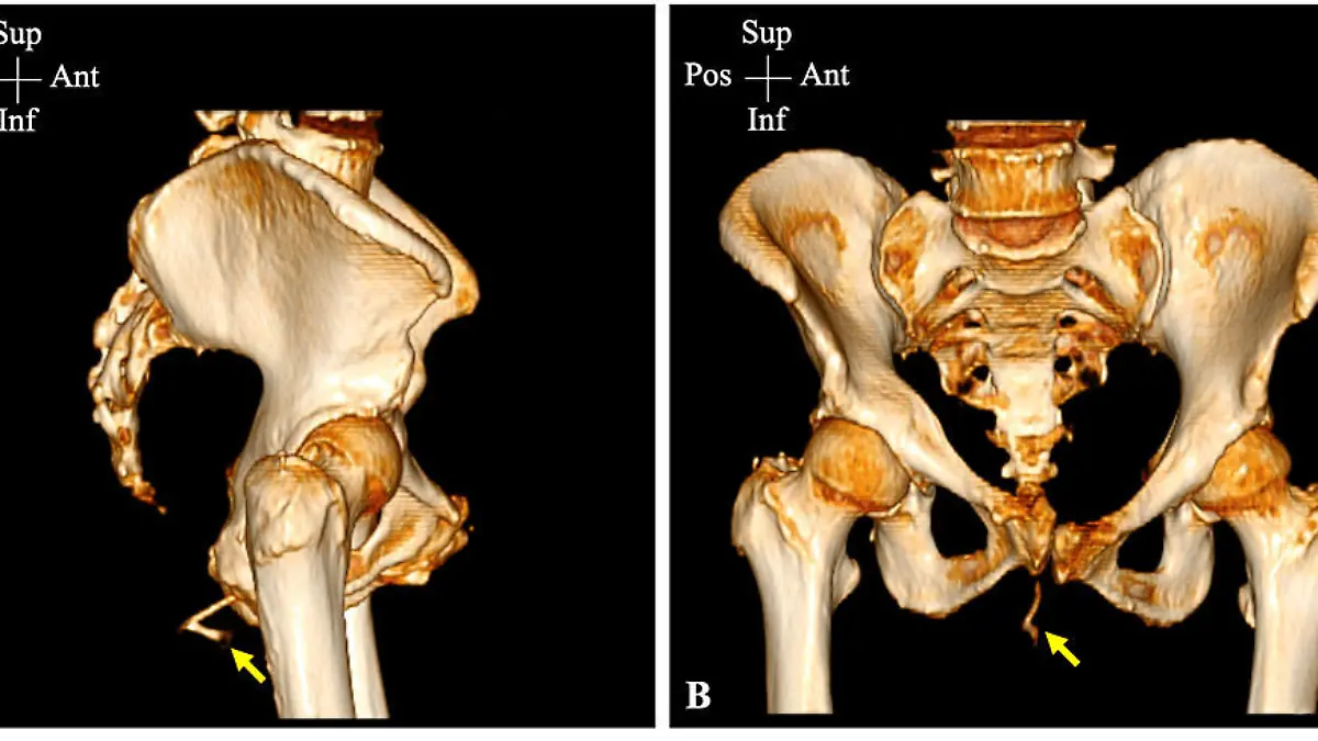 Story from Jam Press (Chicken Bone)
Pictured: A CT scan shows the bone stuck in the woman's bottom.
Woman rushed to hospital after chicken bone gets stuck in her bum.
A woman was rushed to hospital after getting a chicken bone stuck in her bum.
The unnamed woman accidentally swallowed the V-shaped bone after failing to chew her food properly.
The 51-year-old had lost her upper teeth giving her a habit of swallowing her food fast.
She didn't experience any choking or stomach pains after swallowing the triangular-shaped bone.
But when she later went to the toilet she was shocked to find part of the V-shaped bone sticking out of her bottom.
She was rushed to hospital where doctors performed pelvic CT scans.
The 3D scans show the 5cm x 3cm bone firmly wedged in her bottom.
Doctors successfully removed the bone with gentle force before giving the woman gel to numb the area.
The woman, from Kuwait, was told by doctors to chew her food properly and has now been referred to a dentist.
Swallowing chicken bones have been known to be fatal.
The findings were reported in Cureus medical journal.
ENDS