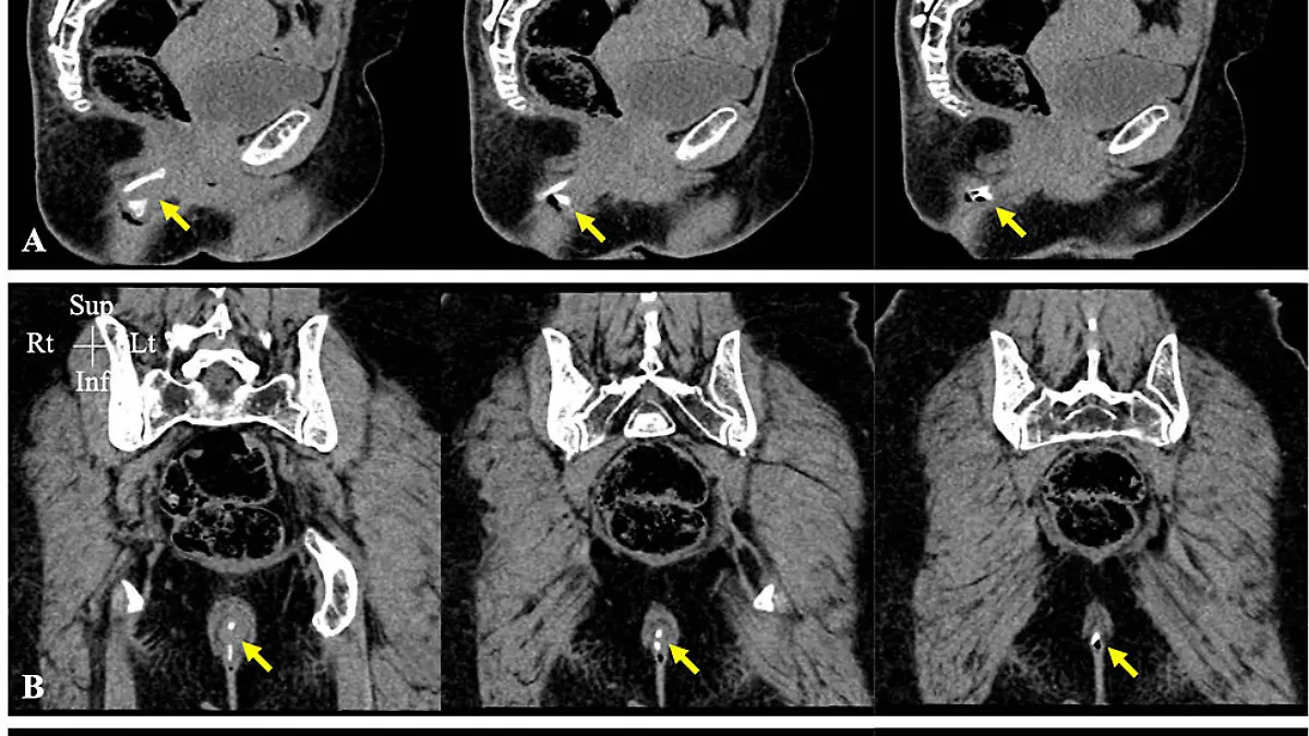 Story from Jam Press (Chicken Bone)
Pictured: CT scans show the bone stuck in the woman's bottom.
Woman rushed to hospital after chicken bone gets stuck in her bum.
A woman was rushed to hospital after getting a chicken bone stuck in her bum.
The unnamed woman accidentally swallowed the V-shaped bone after failing to chew her food properly.
The 51-year-old had lost her upper teeth giving her a habit of swallowing her food fast.
She didn't experience any choking or stomach pains after swallowing the triangular-shaped bone.
But when she later went to the toilet she was shocked to find part of the V-shaped bone sticking out of her bottom.
She was rushed to hospital where doctors performed pelvic CT scans.
The 3D scans show the 5cm x 3cm bone firmly wedged in her bottom.
Doctors successfully removed the bone with gentle force before giving the woman gel to numb the area.
The woman, from Kuwait, was told by doctors to chew her food properly and has now been referred to a dentist.
Swallowing chicken bones have been known to be fatal.
The findings were reported in Cureus medical journal.
ENDS