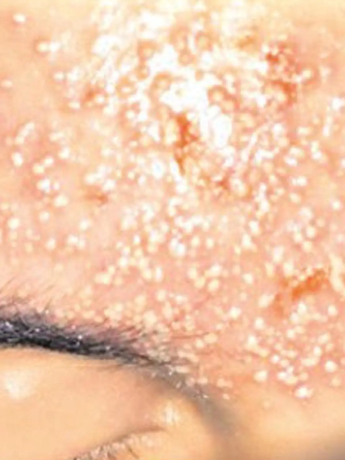 Völlig verätzte Stirn durch Augenbrauen-Waxing.