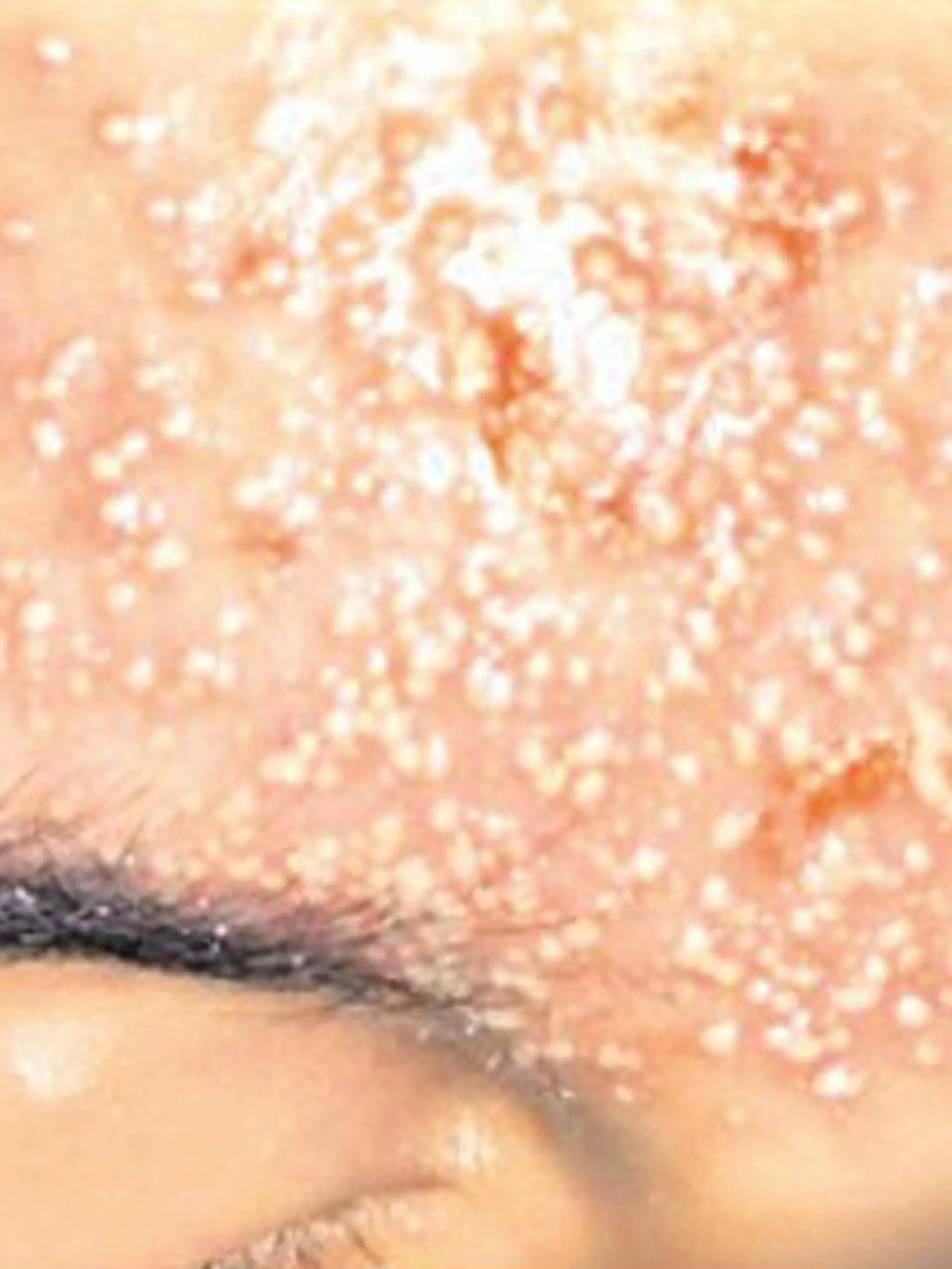 Völlig verätzte Stirn durch Augenbrauen-Waxing.