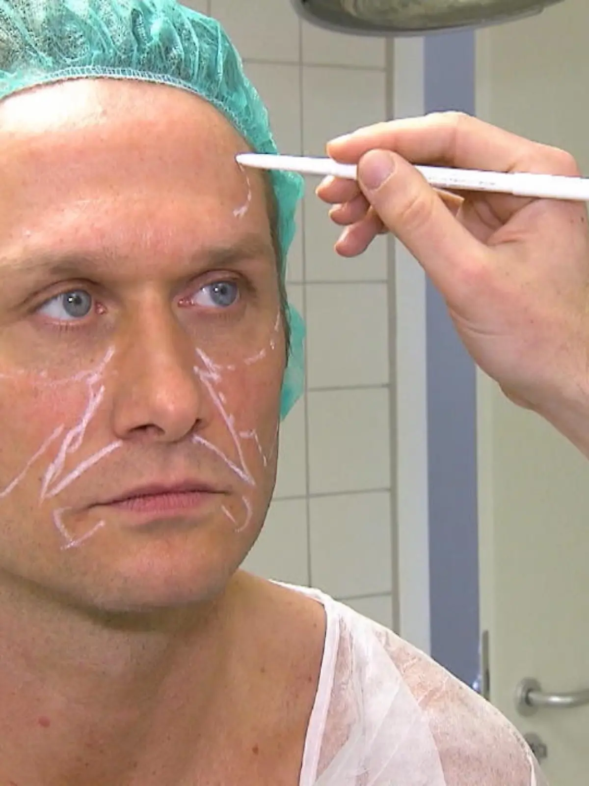 Model Nico Schwanz lässt sich sein eigenes Bauchfett ins Gesicht spritzen.