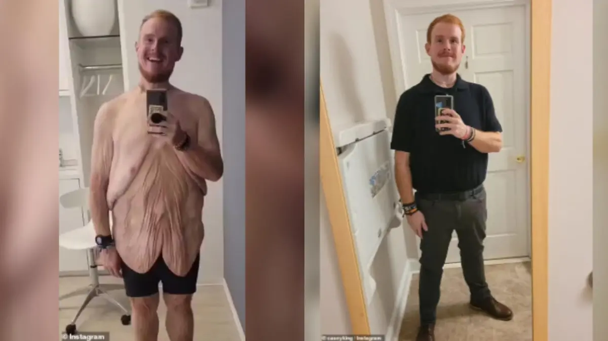 Die Verwandlung vom übergewichtigen Casey ist enorm. Auf zwei Fotos sieht man ihn endlich wieder in Kleidung und auch seine überschüssige Haut ist zu erkennen.