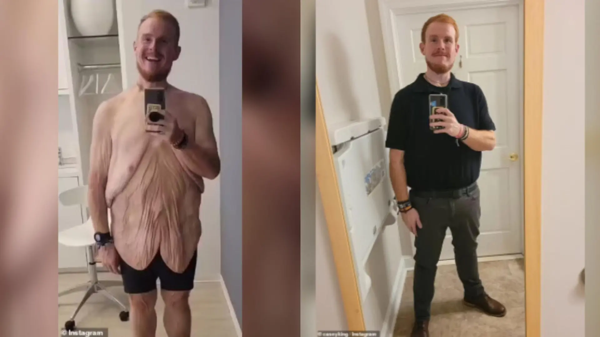 Die Verwandlung vom übergewichtigen Casey ist enorm. Auf zwei Fotos sieht man ihn endlich wieder in Kleidung und auch seine überschüssige Haut ist zu erkennen.