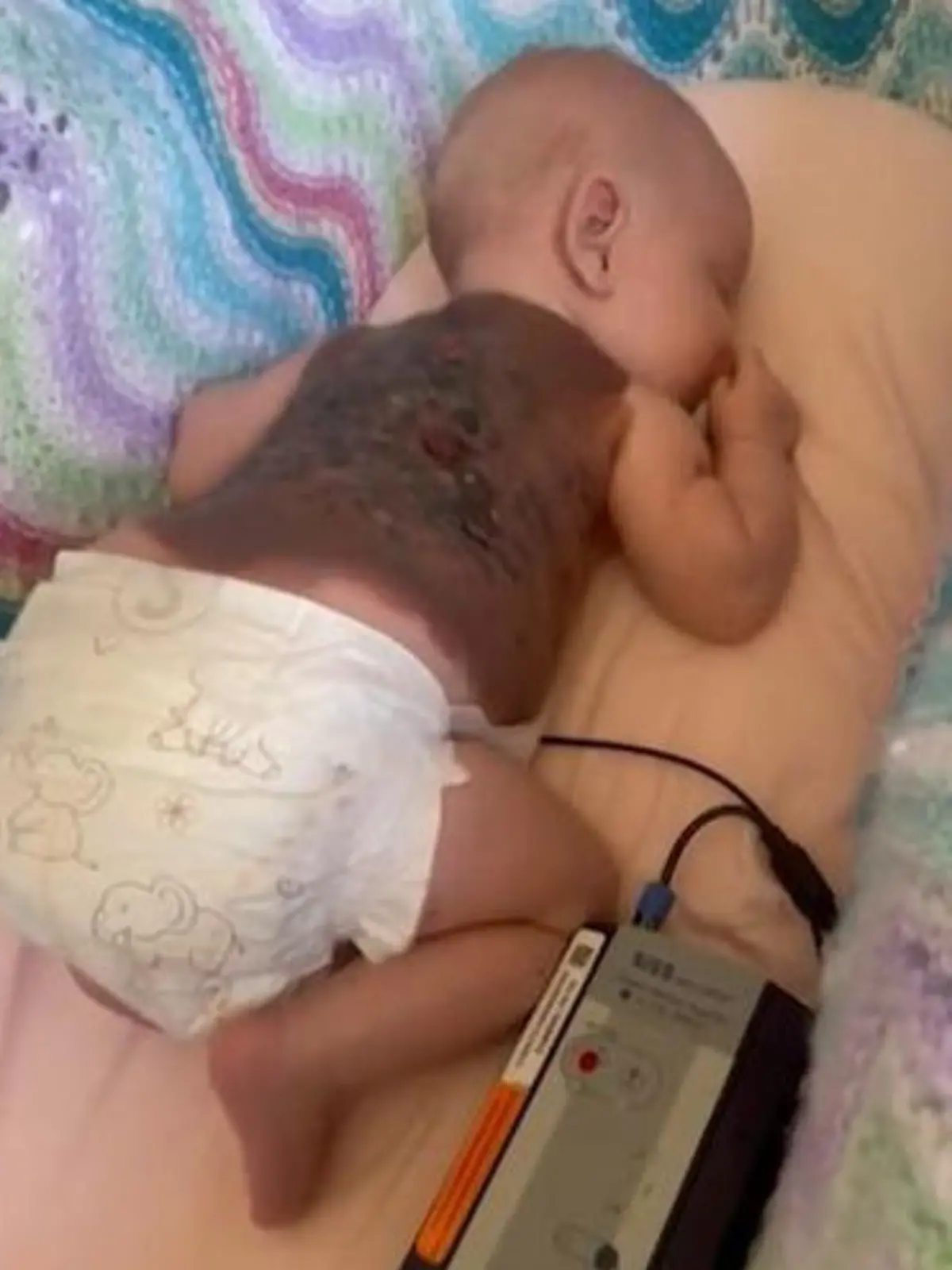 Der Rücken von Baby Macey-Mai ist mit Tumoren übersät