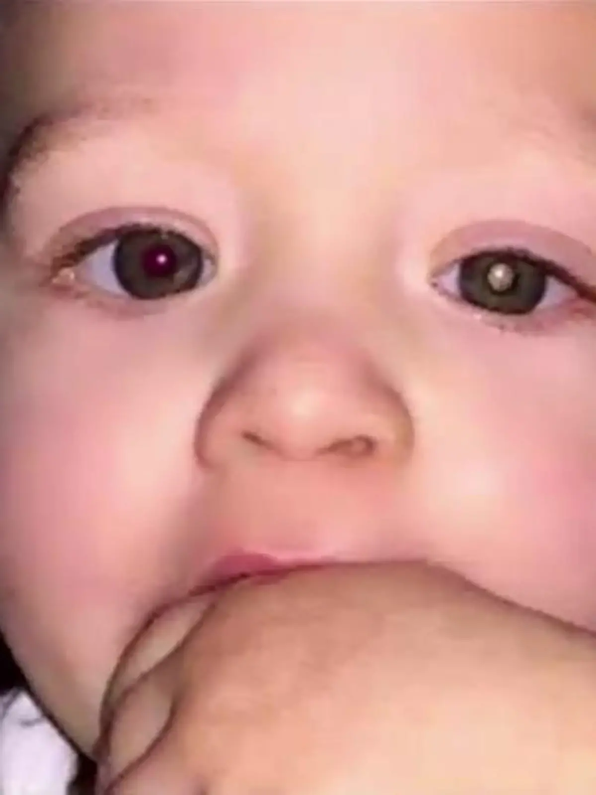 Retinoblastom bei Jaxson