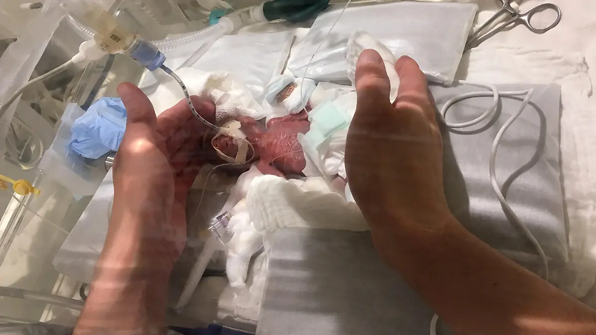 Der kleine Junge kam in der 24. Schwangerschaftswoche per Kaiserschnitt auf die Welt.