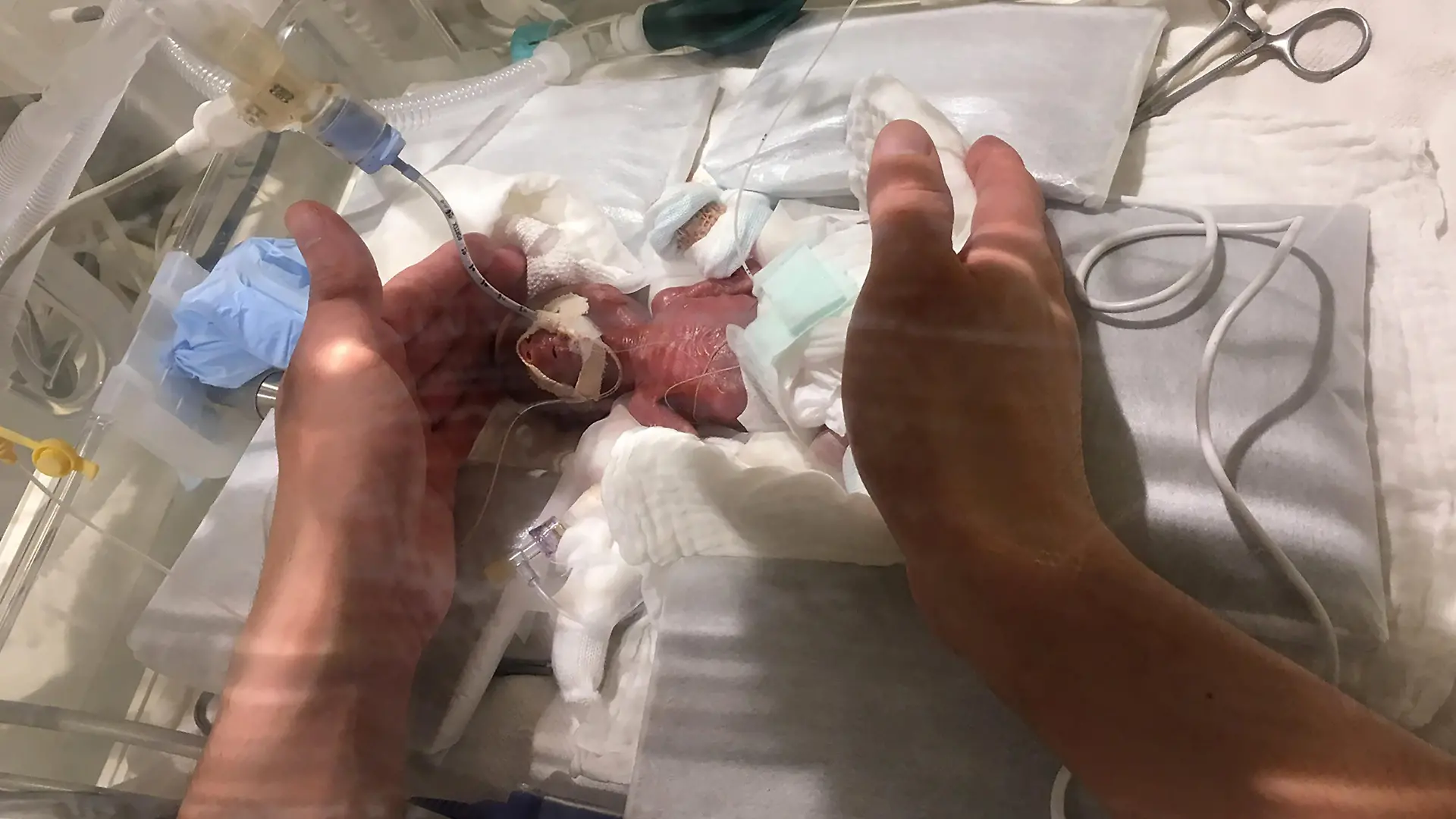 Der kleine Junge kam in der 24. Schwangerschaftswoche per Kaiserschnitt auf die Welt.