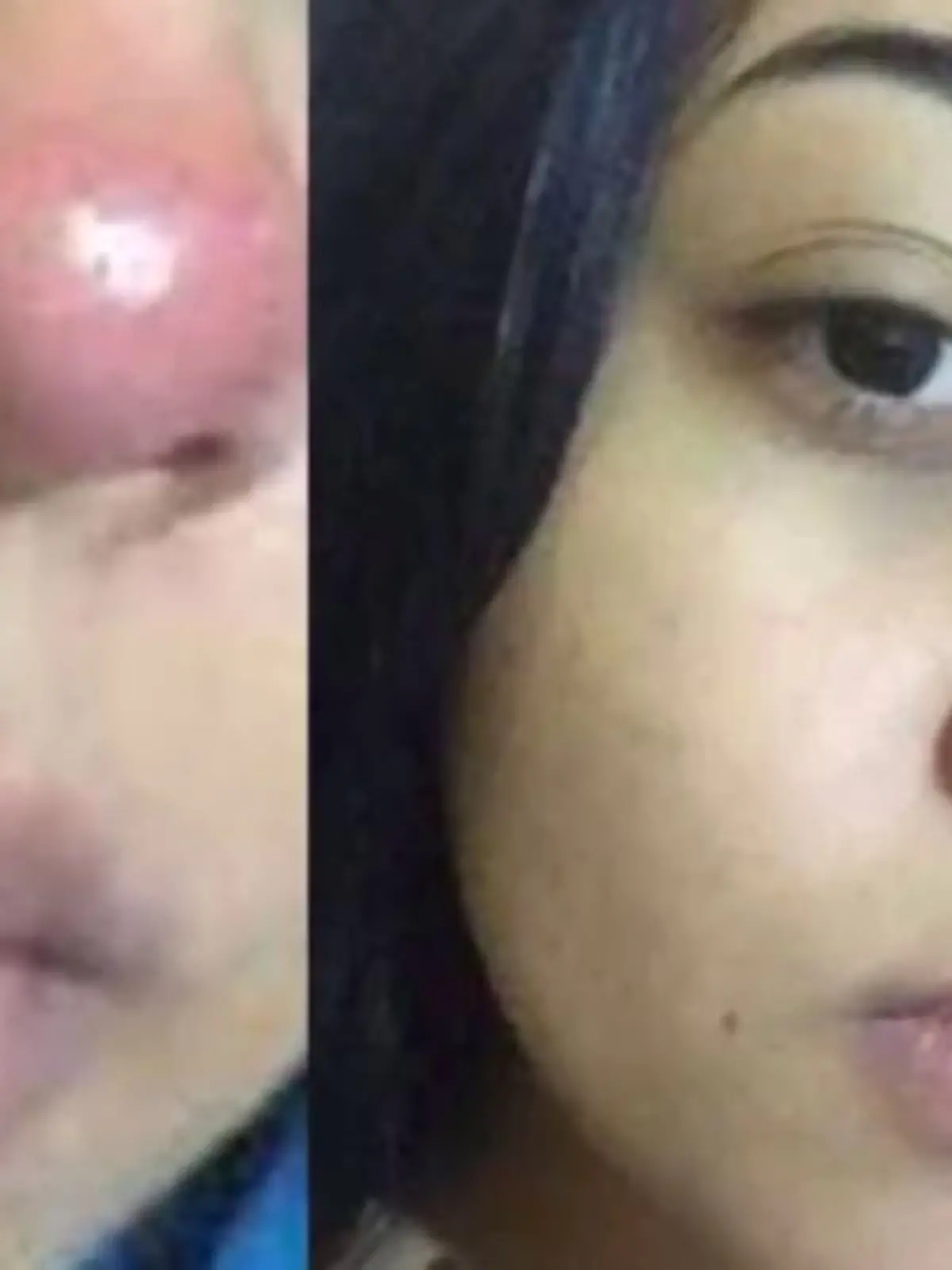 Bild zu: "20-Jährige nach Piercing im Rollstuhl"