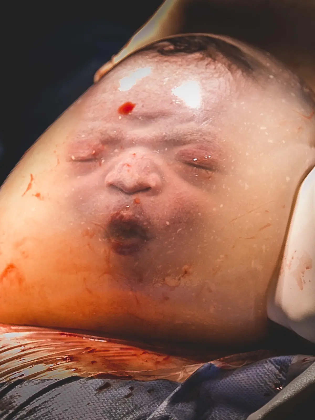 Baby in Fruchtblase geboren