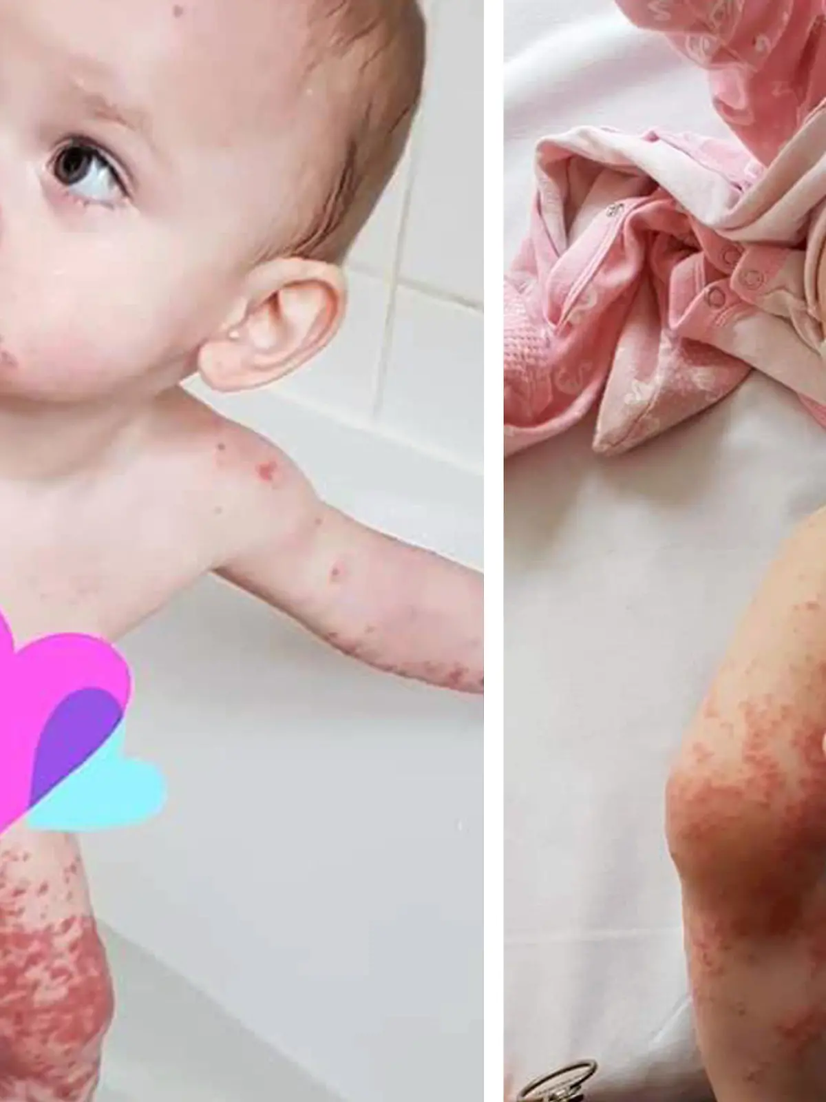Die kleine Kaylah mit Herpes-Ekzemen
