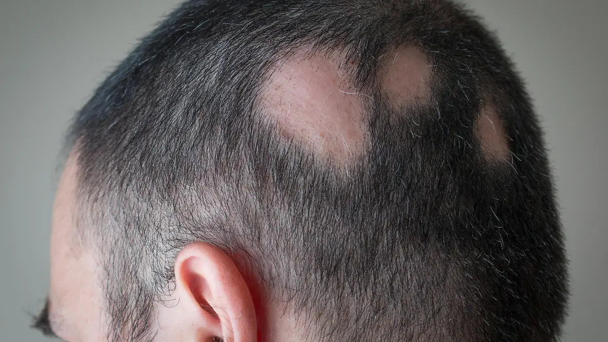 Mann mit kreisrundem Haarausfall.