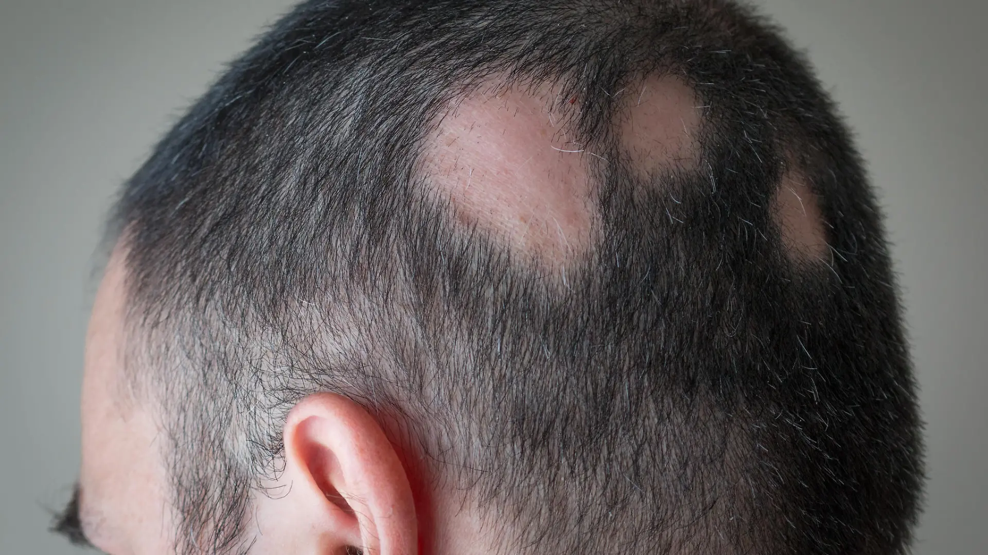 Mann mit kreisrundem Haarausfall.