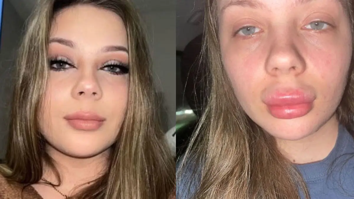 Sie wollte nur ein wenig mehr Fülle für die Lippen. Mutter Natur sah das anders.