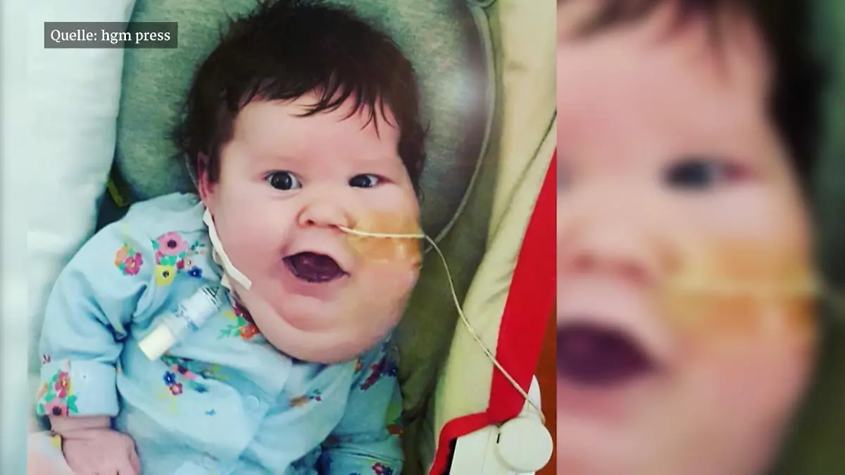 Mädchen mit Zysten im Hals geboren Evie wird nie alleine atmen können