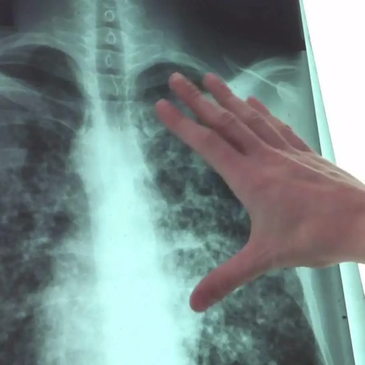 Fibrose Logo von Fibrose