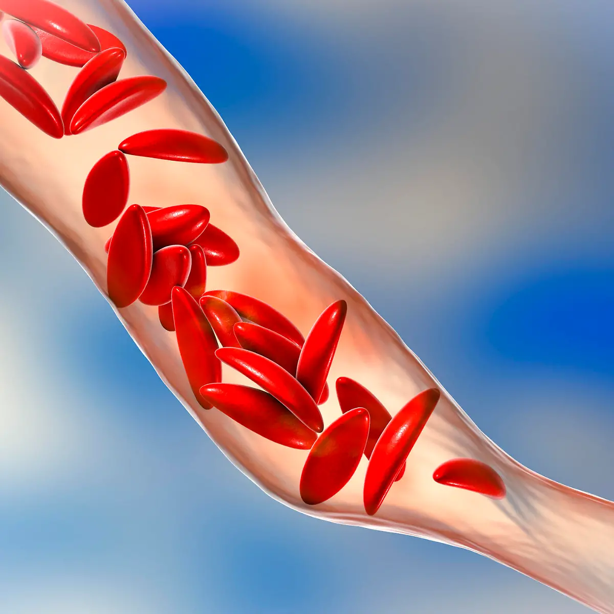 Sichelzellanämie (Sichelzellkrankheit) Logo von Sichelzellanämie (Sichelzellkrankheit)