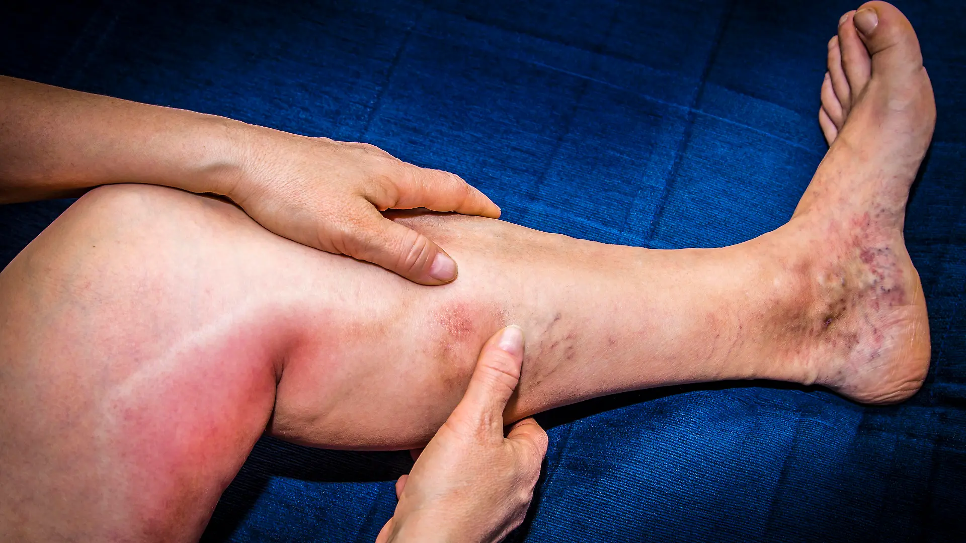 Gesundheitslexikon: Thrombophlebitis
