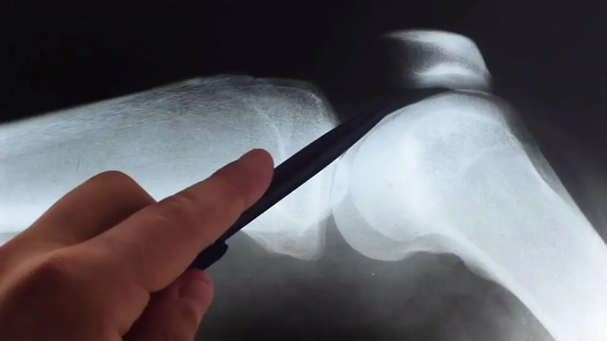 Wieso reißen die Kreuzbänder im Knie? Kreuzbandriss