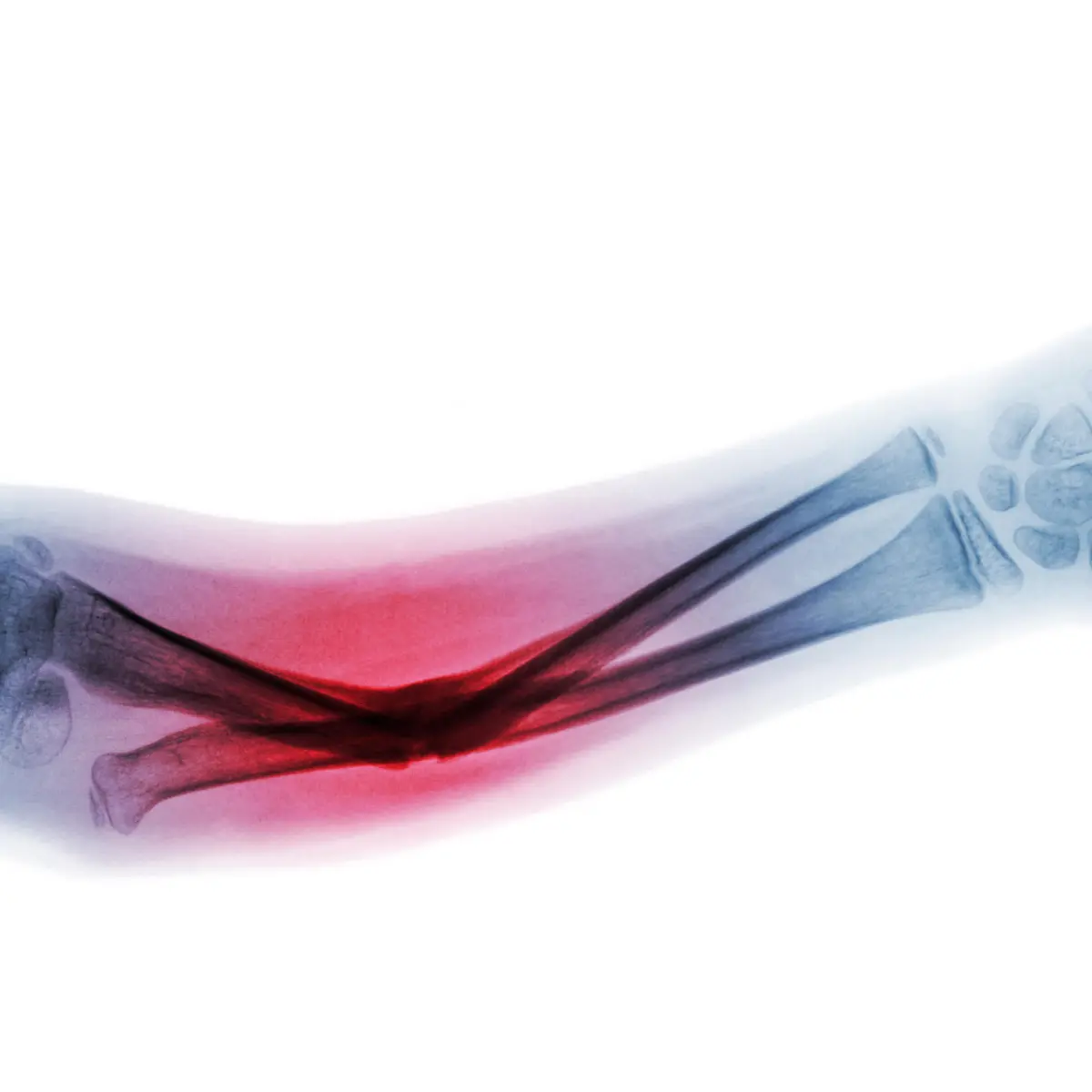 Radiusfraktur Logo von Radiusfraktur