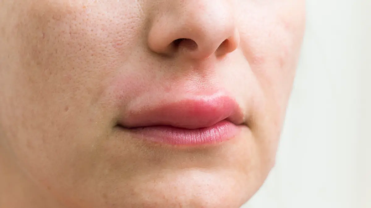 Frau mit geschwollener Lippe (Quincke-Ödem)